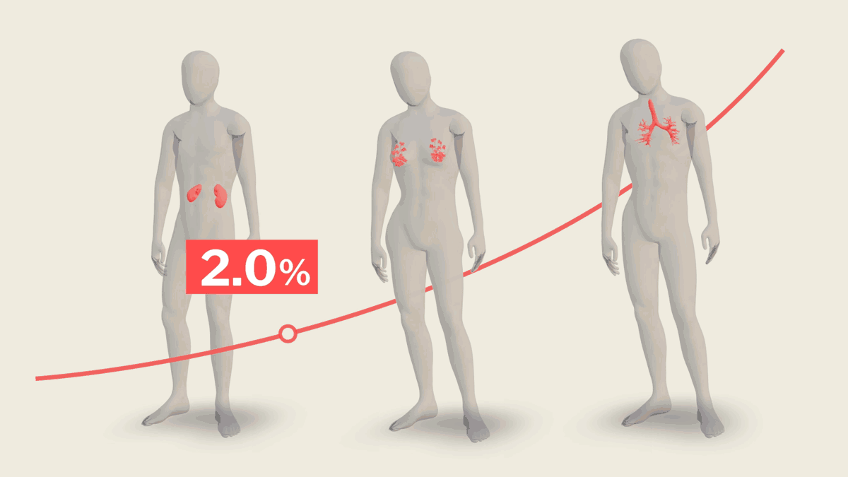 Interaktiver Rechner: So hoch ist das Risiko, an Krebs zu erkranken